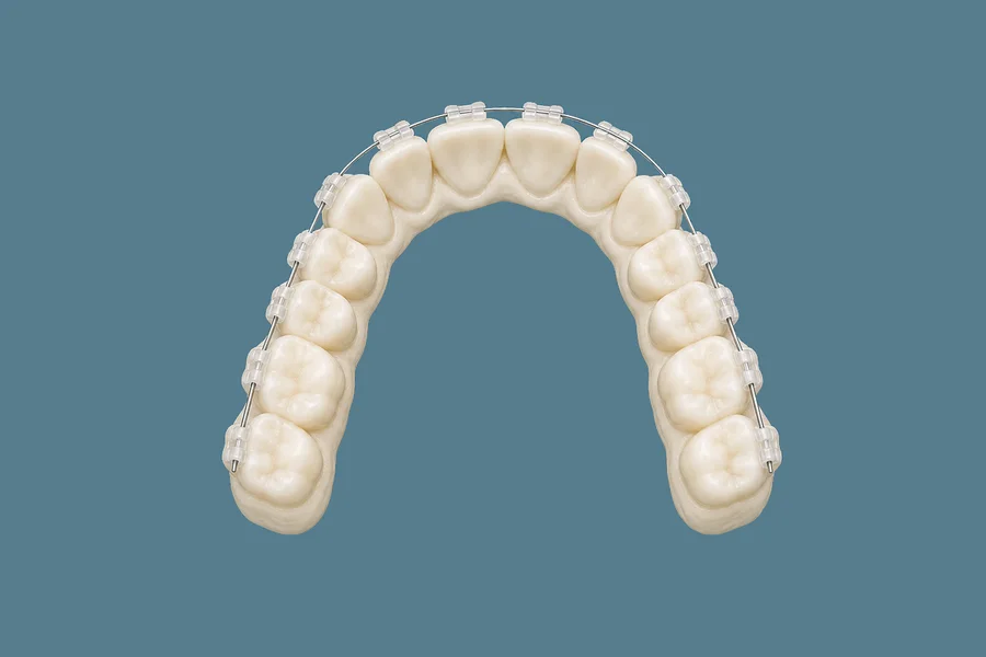 Modelo de arcada con brackets estéticos de cerámica