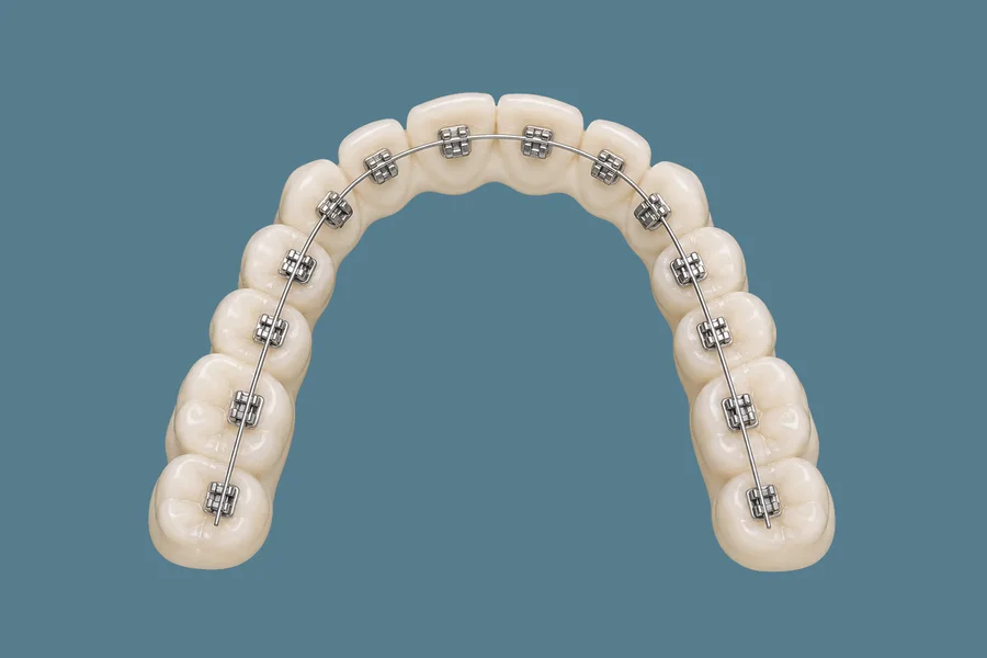 Modelo de arcada con brackets metálicos tradicionales